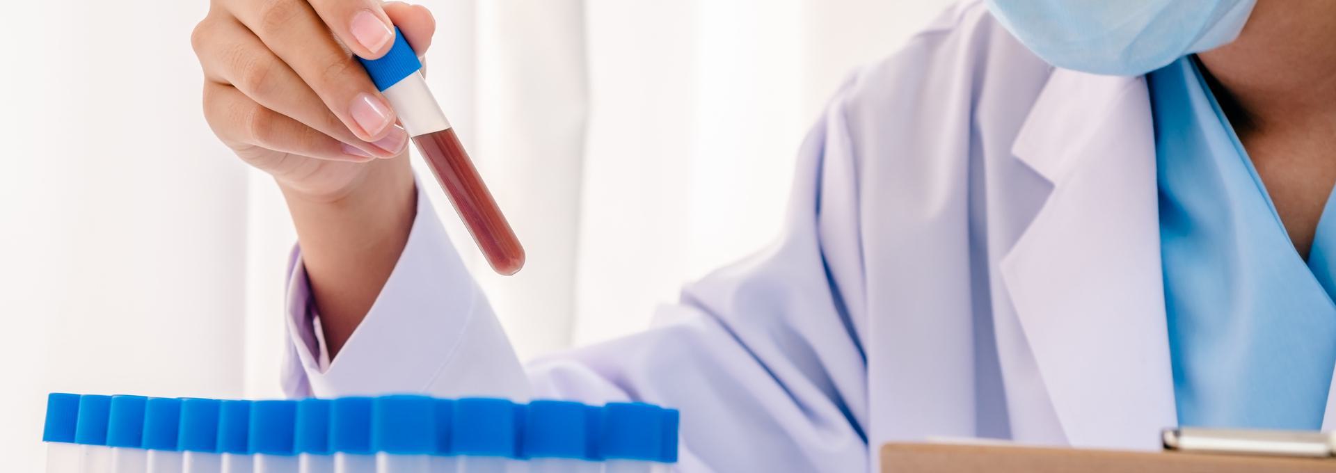 Varicella Titer Scientist holding a test tube with blood sample in a laboratory setting, wearing a lab coat and mask.