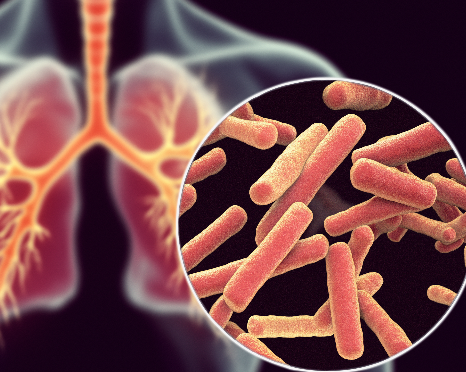 Illustration of human lungs with a close-up view of tuberculosis bacteria.