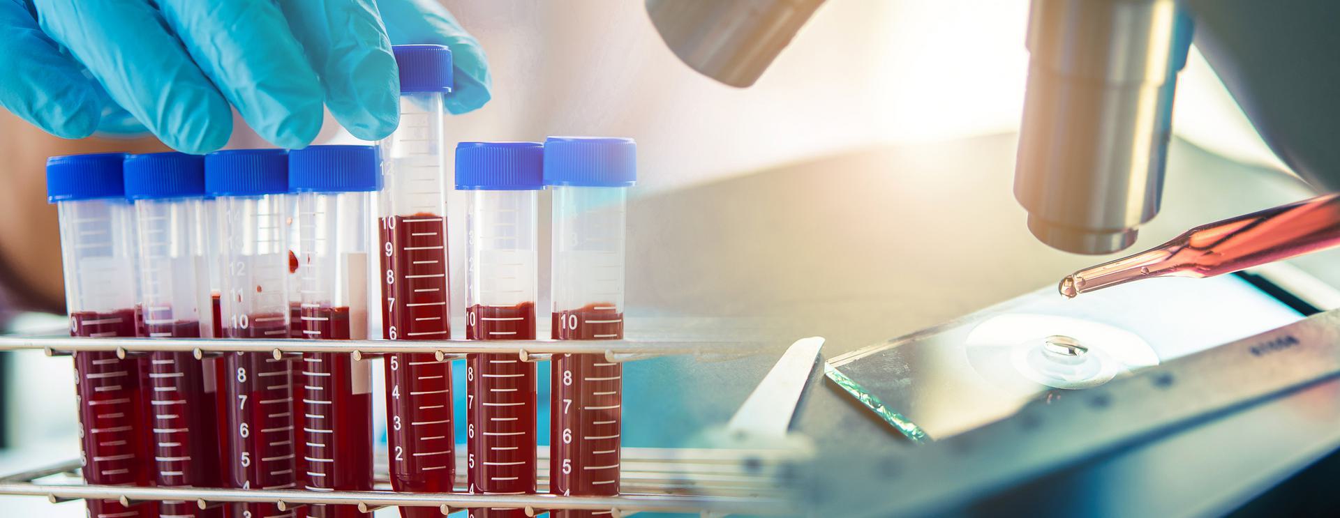 Close-up of test tubes with blood samples and a pipette under a microscope in a laboratory setting.