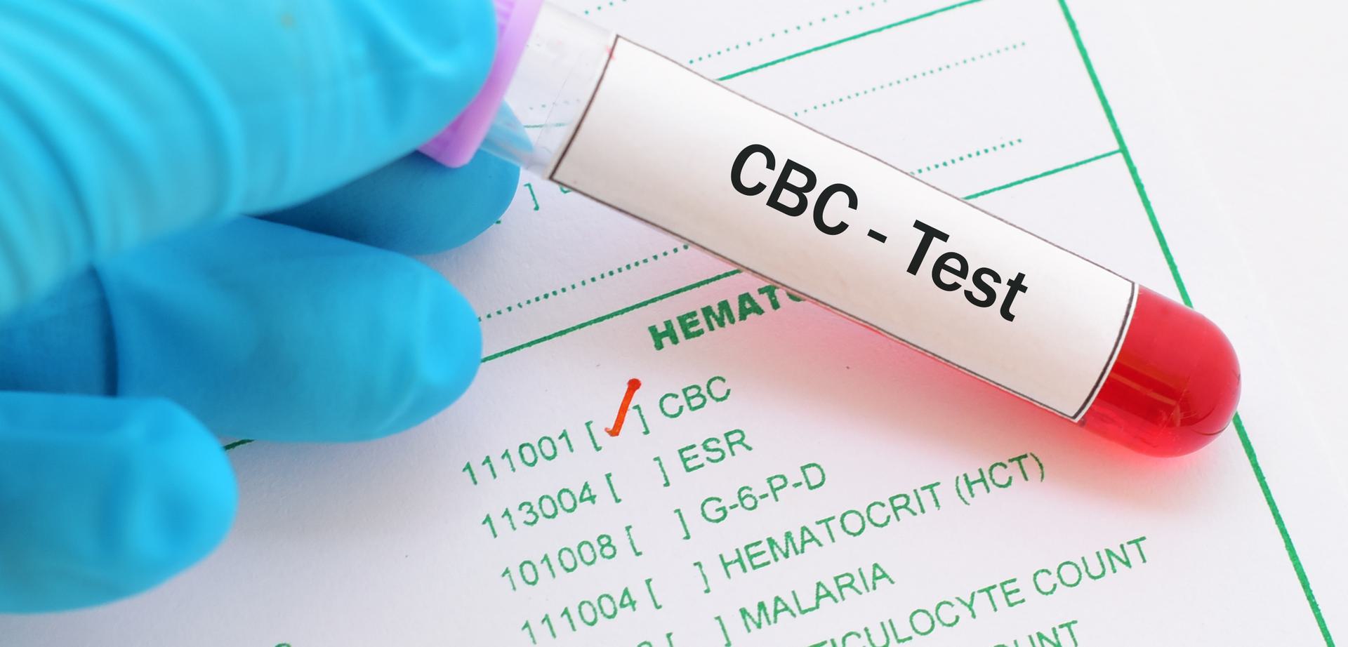 Gloved hand holding a blood sample labeled 'CBC - Test' over a medical form with test options.