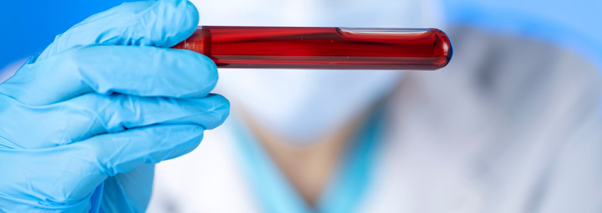 Hepatitis B Surface Antigen Gloved hand holding a test tube filled with blood against a blurred background.