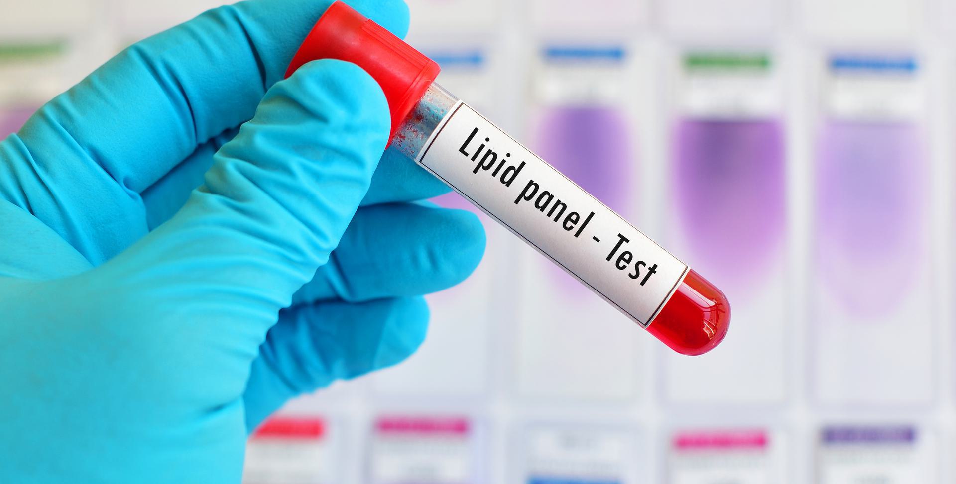 Gloved hand holding a test tube labeled 'Lipid panel - Test' with blurred background of other samples.