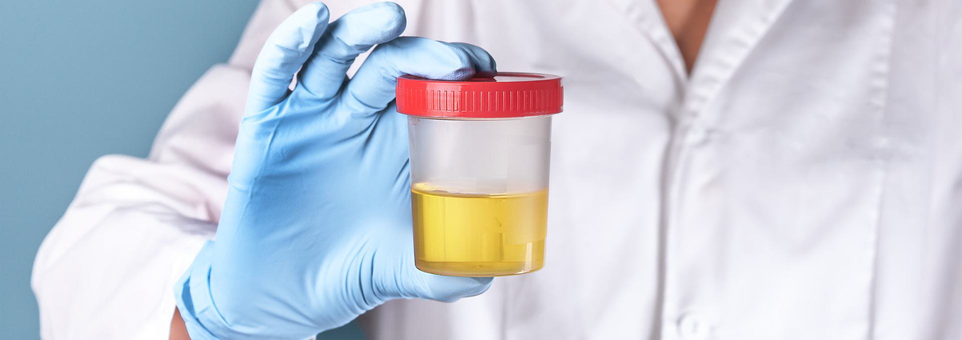 Person in a lab coat holding a urine sample container with a red lid and wearing blue gloves.