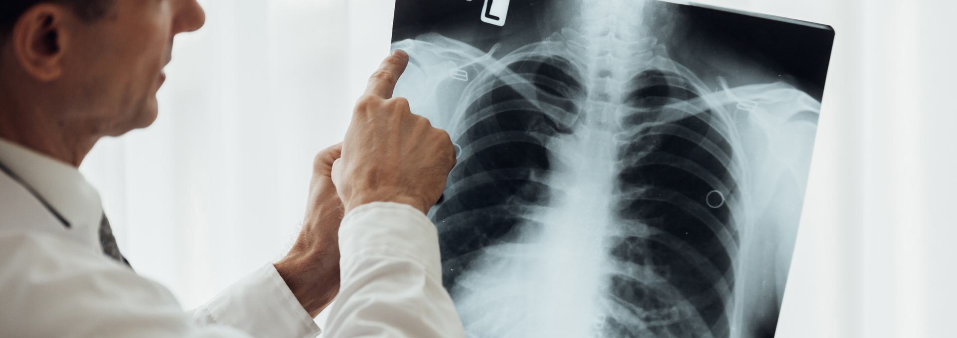 Chest X-Ray Doctor examining a chest X-ray image, pointing at the ribs and spine.