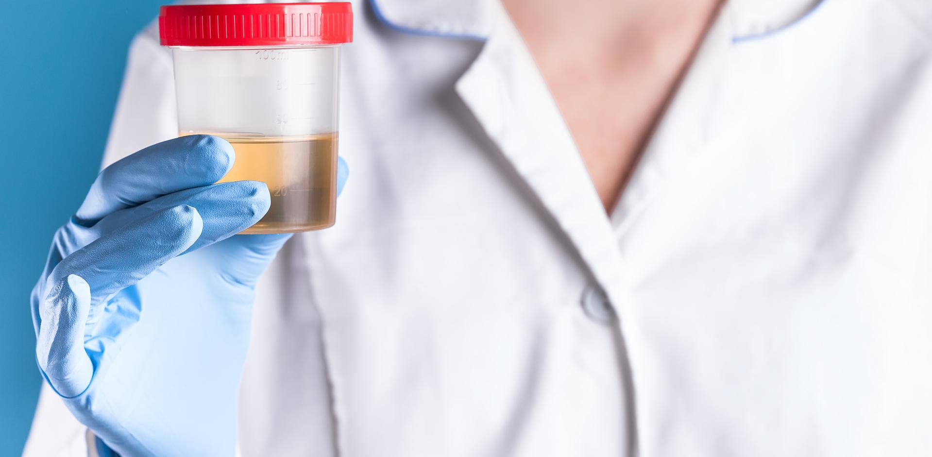 Person in a lab coat holding a urine sample container with a red lid, wearing blue gloves.